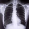 262068_chest_xray